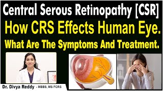 Central Serous Retinopathy  Causes Symptoms amp Treatment  CSR  Best Vision Eye Hospital [upl. by Nithsa931]