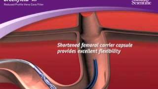 Greenfield Vene Cava Filter  Boston Scientific [upl. by Richella661]