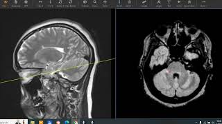 27 year old with extremity weakness and numbness [upl. by Anitap]