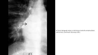 Bronchogenic Cyst Imaging [upl. by Manella44]