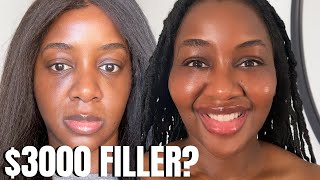 LIP FILLER VLOG  Before and after  the healing process [upl. by Carbo269]