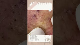 Big Cystic Acne Blackheads Extraction Blackheads amp Milia Whiteheads Removal Pimple Popping shorts [upl. by Ynnaf419]