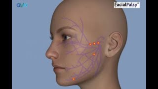 Understanding Facial Palsy [upl. by Ardnasil]