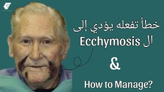 خطأ في العيادة يؤدي إلى ال Ecchymosis وكيفية التعامل في حالة حدوث ذالك [upl. by Jeffries]