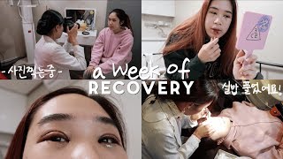 DOUBLE EYELID SURGERY Recovery Vlog in Seoul 👁🕶 Swelling Getting Stitches Out [upl. by Hajan835]