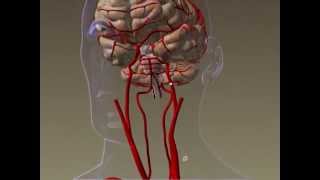 ADAPT Thrombectomy at Holy Cross Hospital Fort Lauderdale [upl. by Theresa]