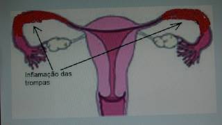 Inflamaçâo das trompasMP4 [upl. by Jocelyn]