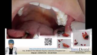 Exodoncia diente 27 caries extensa [upl. by Darmit]