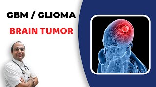 Glioma Brain Tumour Treatment  GlioblastomaGBM Cancer  दिमाग का कैंसर  Best Homeopathic Doctor [upl. by Orian]