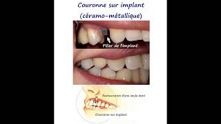 Pourquoi fautil remplacer une dent manquante Jildent Clinique  Budapest [upl. by Rebba]