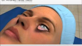 Blefaroplastia inferior [upl. by Helen3]