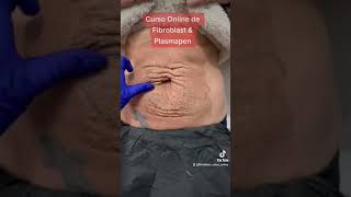 Aprende a tensar la piel flácida del abdomen con Plasmapen fibroblast plasmapen sincirugia [upl. by Conard]