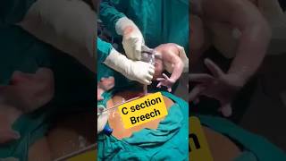 c sectionbreech deliverybaby birthshortsvideo [upl. by Nnawtna]