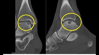 Osteochondral Defects of Talus [upl. by Anayet]