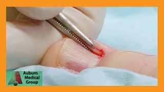 Double Toe Procedure with Partial Nail Removal  Auburn Medical Group [upl. by Ilrebma]