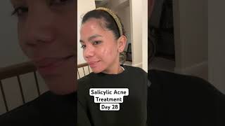 Testing LaRoche Posay Salicylic Acne Treatment shorts acne acnetreatment shortvideo [upl. by Aoht]