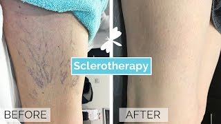 Sclerotherapy for Spider and Varicose Veins [upl. by Ahsinhoj]