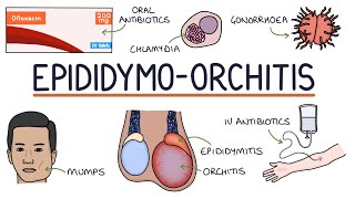 Understanding Epididymoorchitis [upl. by Ripleigh]