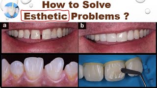 How to Solve Dental Esthetic Problems [upl. by Lee]