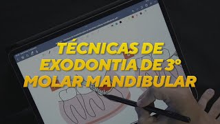 TÉCNICAS DE EXODONTIA para os terceiros molares mandibulares [upl. by Edward]