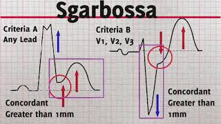 Current ECG Ep 4 Sgarbossa Criteria STEMI LBBB [upl. by Rives]