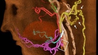 Face Transplant Blood Vessels Reorganize 1 Year Later [upl. by Oralia]