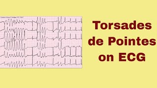 Torsade de Pointes on ECG [upl. by Hammerskjold]