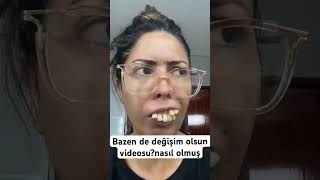 Değişim nasıl laminediş zirkonia dentistry implant [upl. by Corell461]