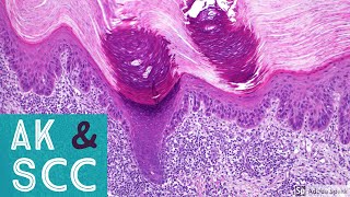 Squamous Cell Carcinoma amp Actinic Keratosis 101Dermpath Basics amp Beyond [upl. by Raphael]