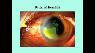 Keratitis  CRASH Medical Review Series [upl. by Nerfe]