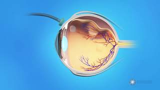 Vitrectomy Surgery for Detached Retina [upl. by Waki684]