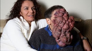 10 People with Extreme Deformities [upl. by Wiltshire]