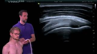 Demonstratie echografie supraspinatus lengte opname [upl. by Bilbe]