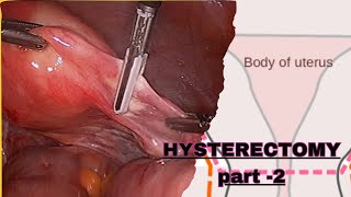 PART  2  NURSING CARE PLAN OF HYSTERECTOMY POST OPERATIVE MANAGEMENT GYNECOLOGICAL NURSING [upl. by Montano]