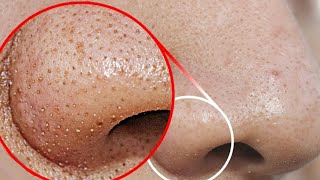 how to remove blackheads from nose and chin area naturally and permanently  DIY blackhead removal [upl. by Initof]