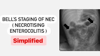 Bells Staging of NEC  Necrotising Enterocolitis  MisMedicine highyield [upl. by Chernow]