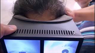 Multicanal BPPV with Canal Switch and Jam [upl. by Rede]