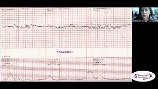 CARDIOTOCOGRAFÍA FETAL DE PATRÓN NORMAL Y PATOLÓGICO CLASE V [upl. by Eerihs]