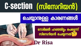 Csection  Reason for Cessarian Delivery Malayalam [upl. by Otreblide]