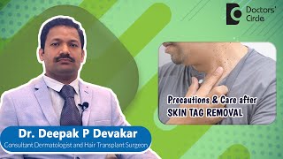 SKIN CARE After LASER SKIN TAG REMOVAL  Radiofrequency Laser  Dr Deepak P DevakarDoctors Circle [upl. by Alissa]