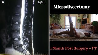 Microdiscectomy 1 Month Post Surgery L5S1 [upl. by Nosyarg]