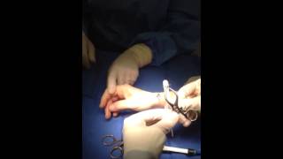 1st Dorsal Compartment Release for Dequervains Tenosynovitis [upl. by Fabri]