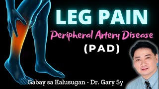 Leg Pain Peripheral Artery Disease PAD  Dr Gary Sy [upl. by Atnuahs21]