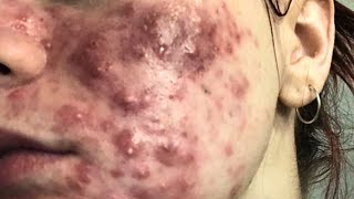 cystic acne blackhead whitehead removal  Relaxing Spa Acne Treatment [upl. by Ohare175]