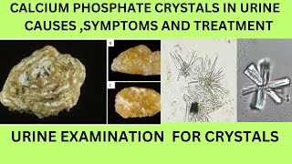 CALCIUM PHOSPHATE CRYSTALS IN URINECAUSES SYMPTOMS TREATMENT OF CALCIUM PHOSPHATE STONES [upl. by Wilkins]