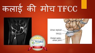 TFCC Injury Hindi Wrist ligament Injury कलाईकीमोच [upl. by Nyrrat362]