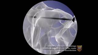 Odontoid Screw for Odontoid Fracture [upl. by Cyrie818]