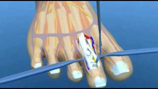 Hammer Toe Surgery Explained Podiatry Claw Toe Mallet Toe [upl. by Anyzratak28]