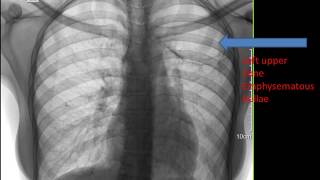 CASE 291 LEFT UPPER EMPHYSEMATOUS BULLAE [upl. by Dawes]