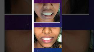 Forwardly Placed Front Teeth Correction with Braces [upl. by Nolyarg287]